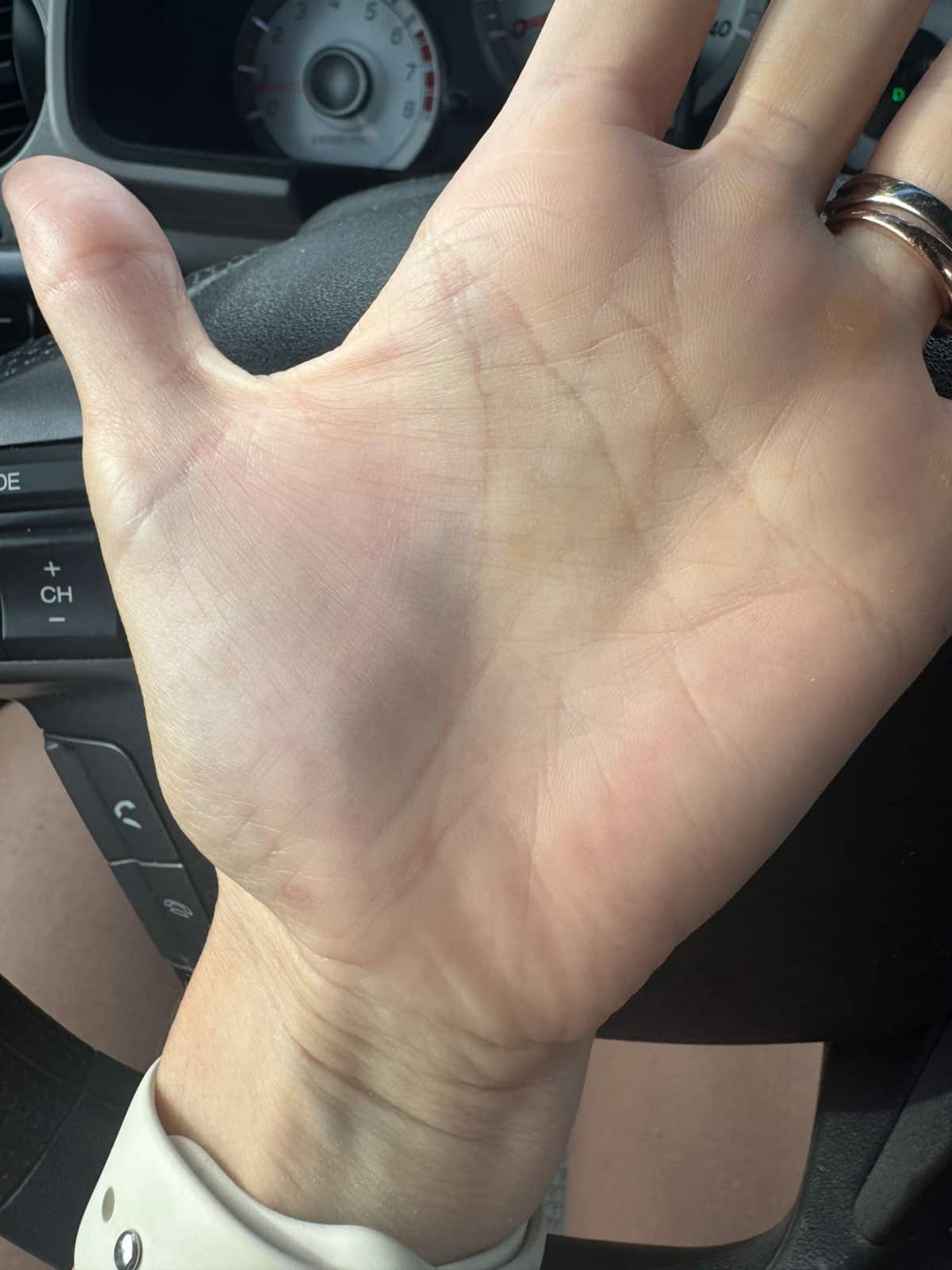 blood clot hand
